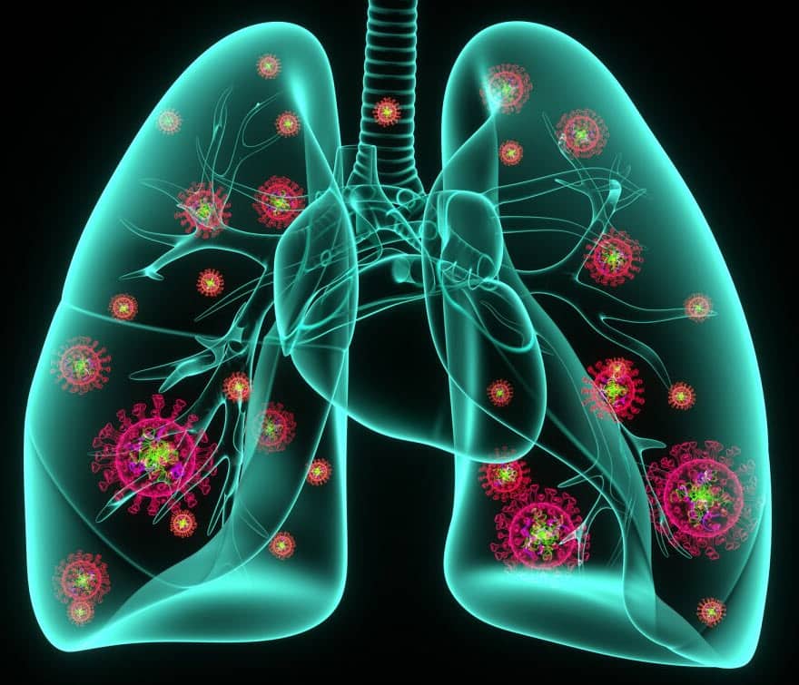 Pneumonia